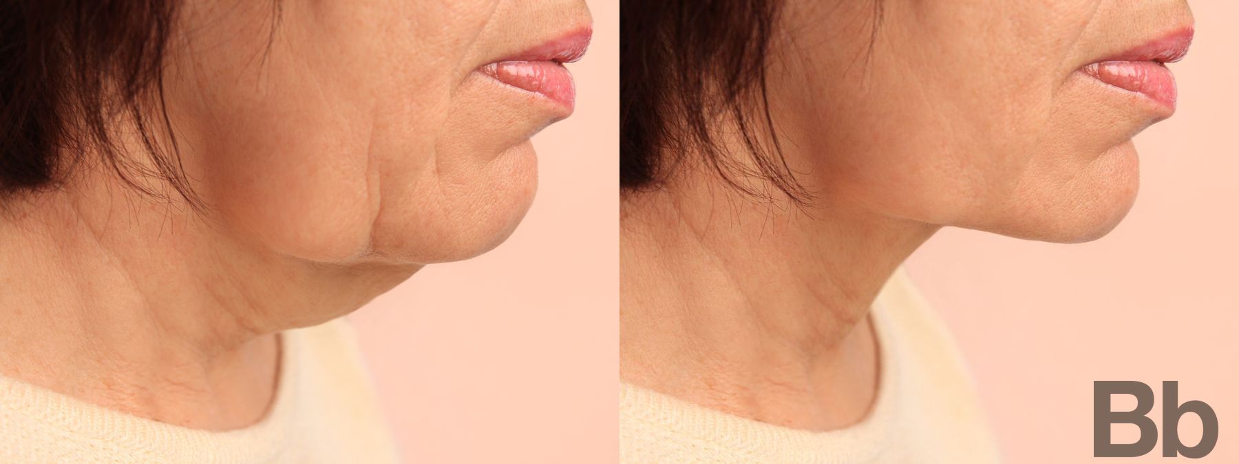 Before and after Chin Augmentation case 4775