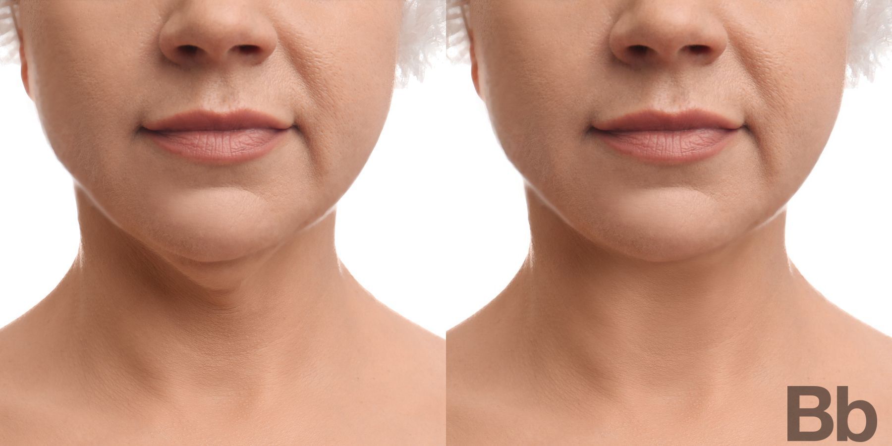 Before and after Chin Augmentation case 13459