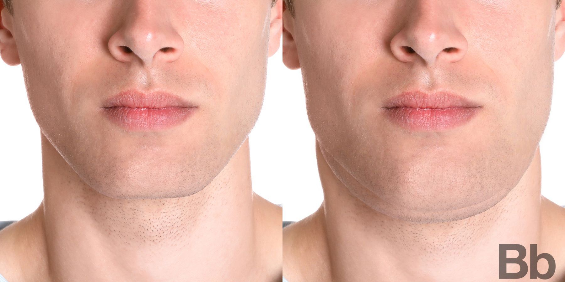 Before and after Chin Augmentation case 6278