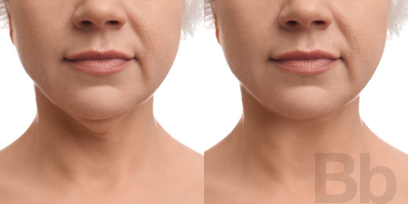 Chin Augmentation - Thumbnail 2