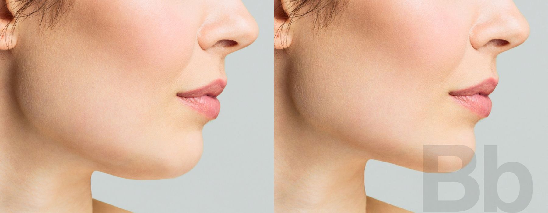 Double Chin - Kybella - Case 105