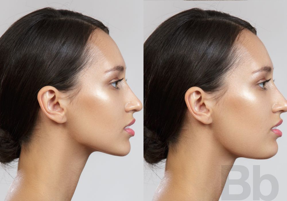 Double Chin - Kybella - Case 107