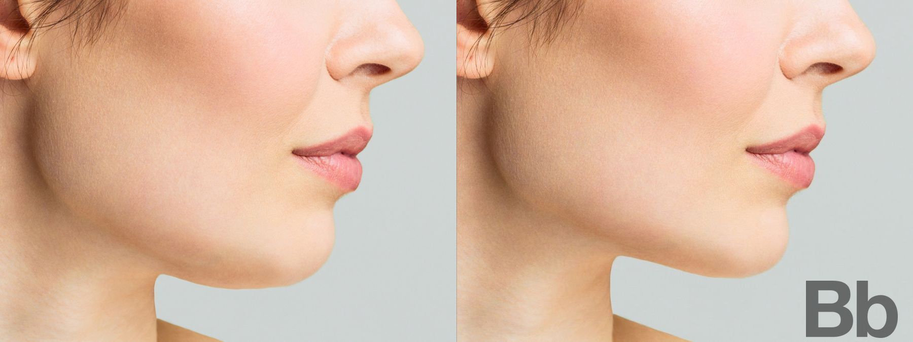 Before and after Fillers case 4776