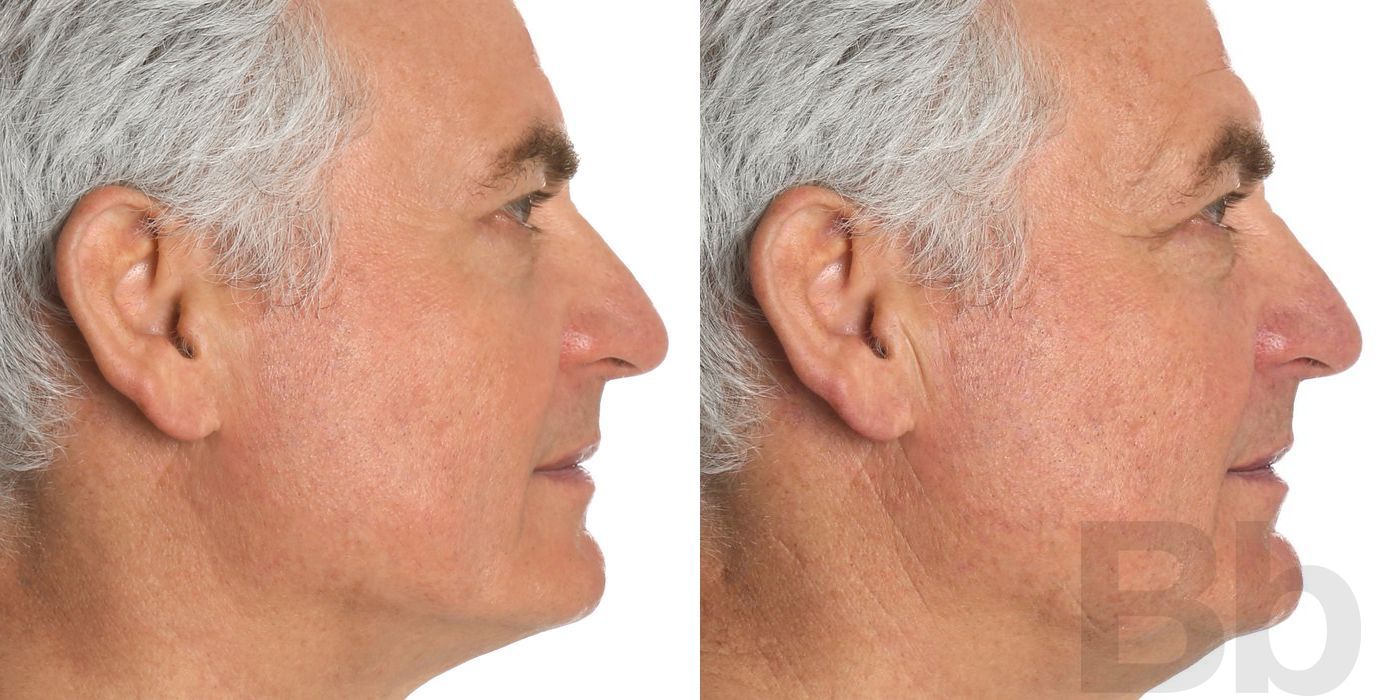 Double Chin - Kybella - Case 108