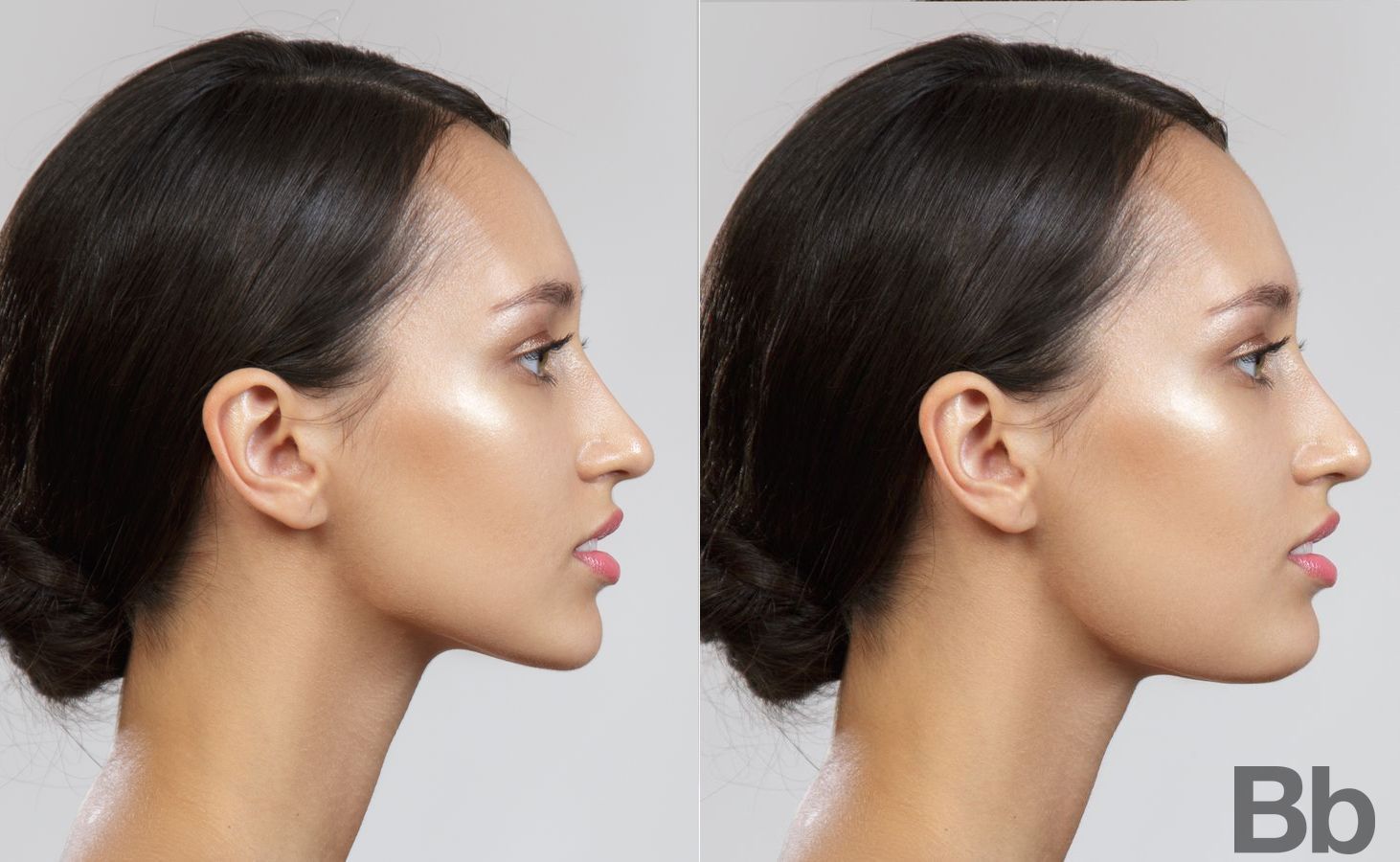 Before and after Blepharoplasty case 18547