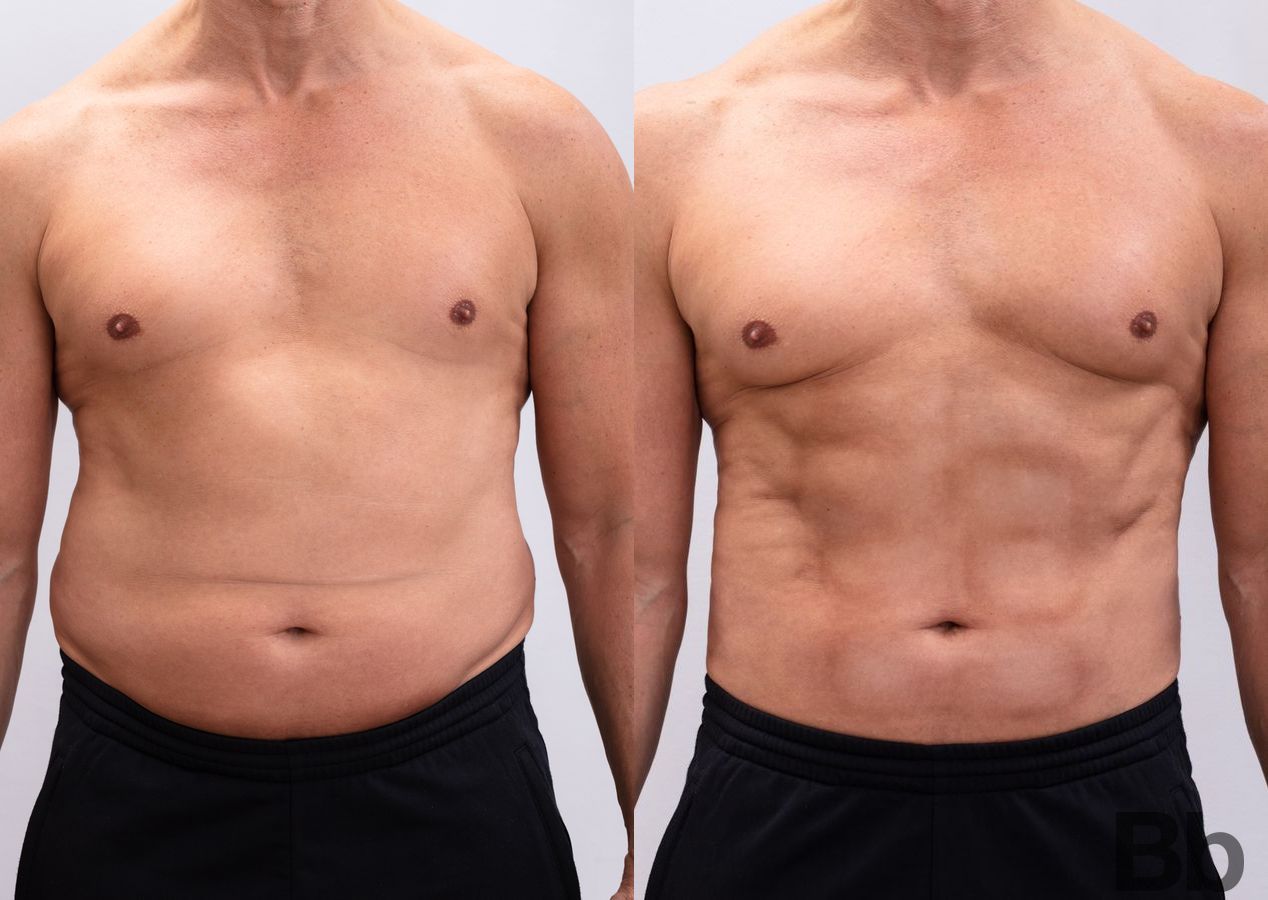 Before and after Liposuction case 4762