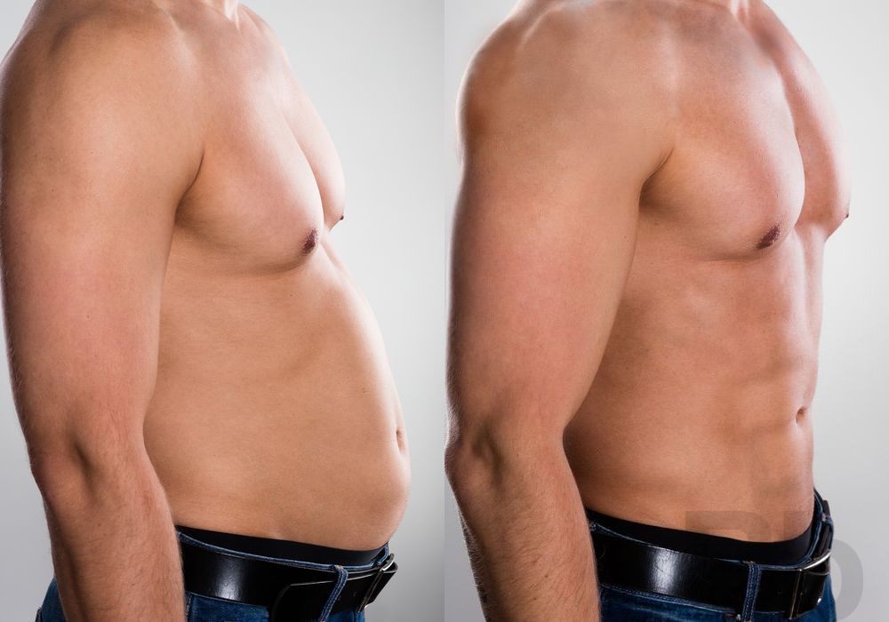 Liposuction - Thumbnail 2