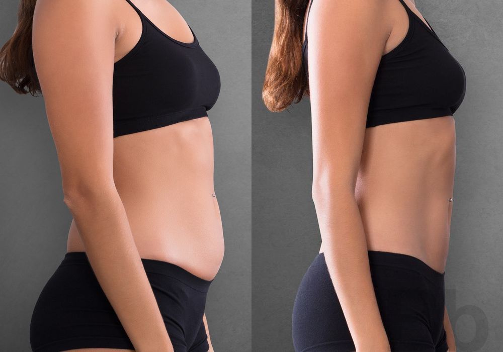 Liposuction - Thumbnail 2