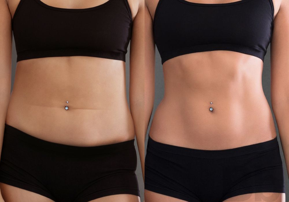 Liposuction - Case 22