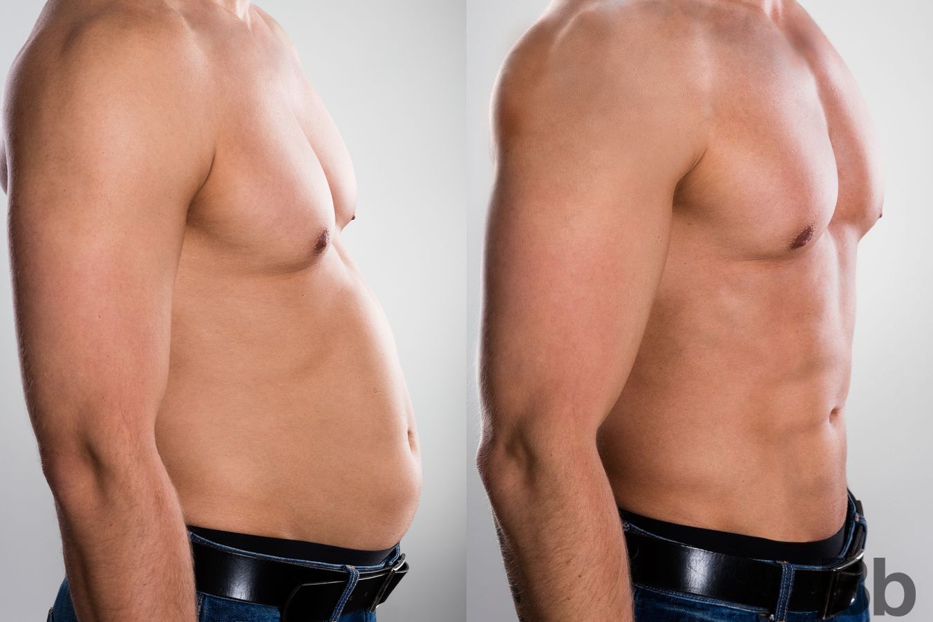 Before and after Liposuction case 4762 - Angle 2