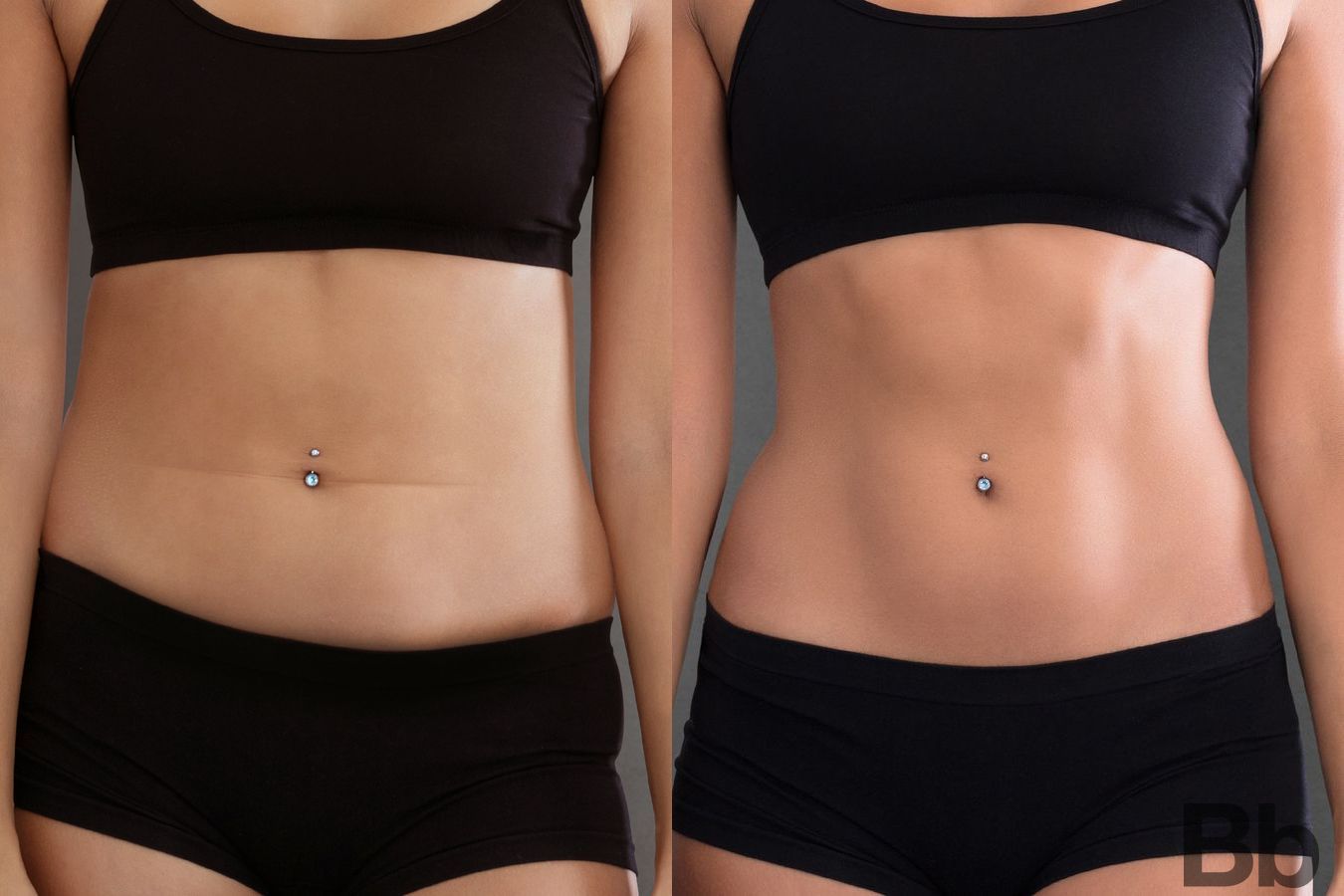 Before and after Liposuction case 4761