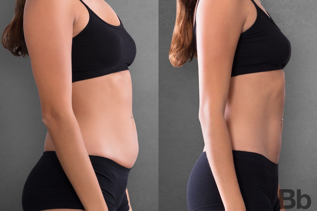 Before and after Liposuction case 4761 - Angle 2