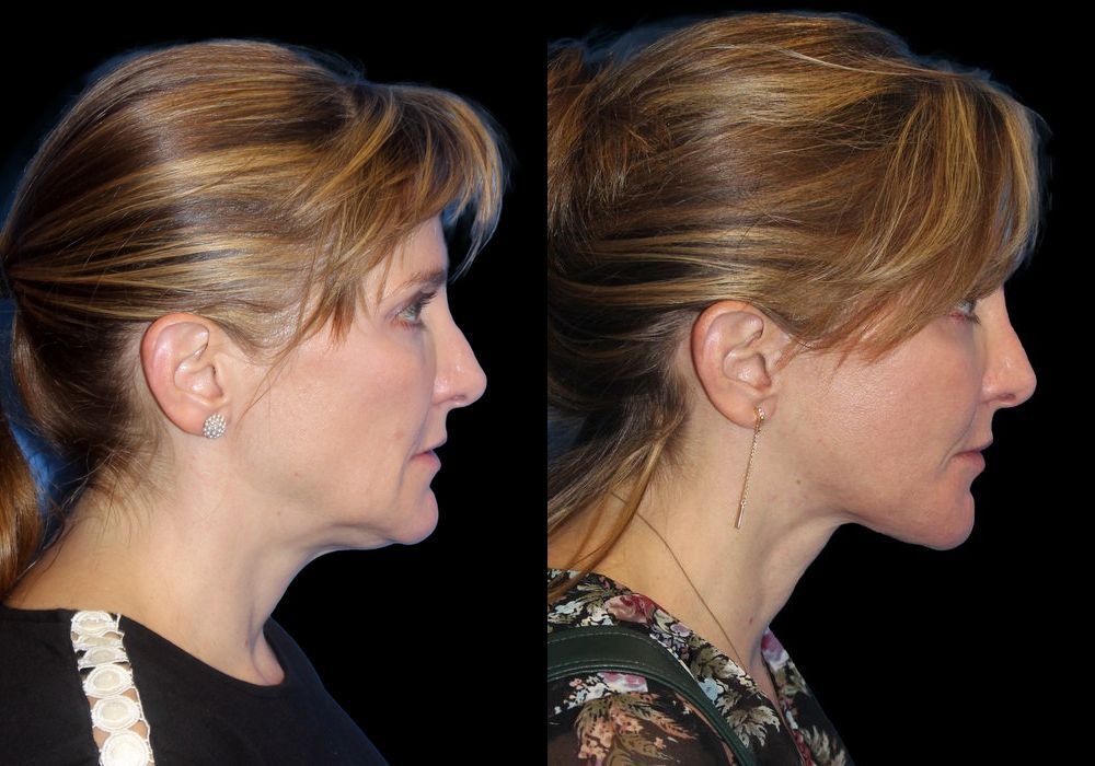 Neck Lift - Case 115