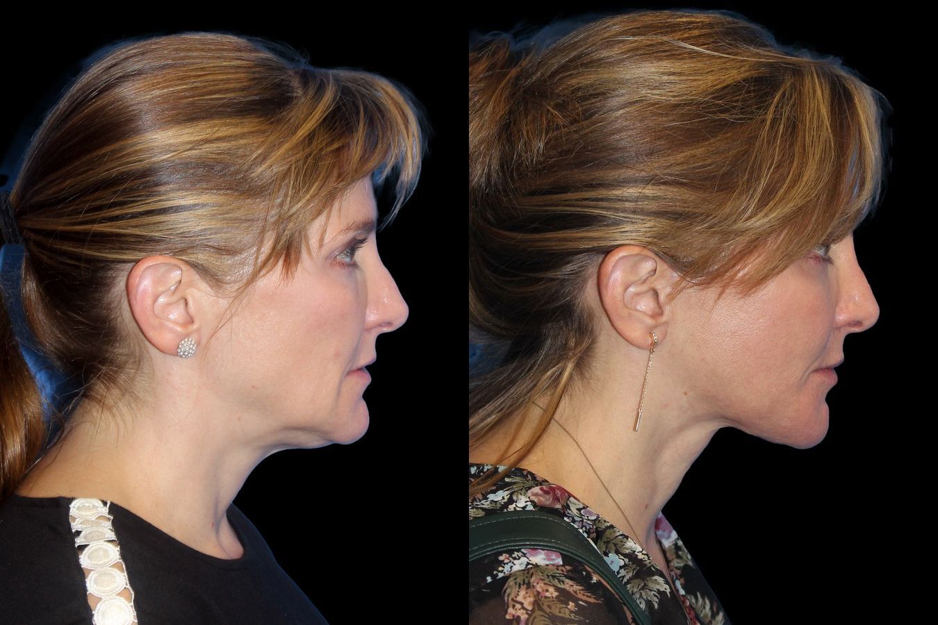 Before and after Facelift case 19719