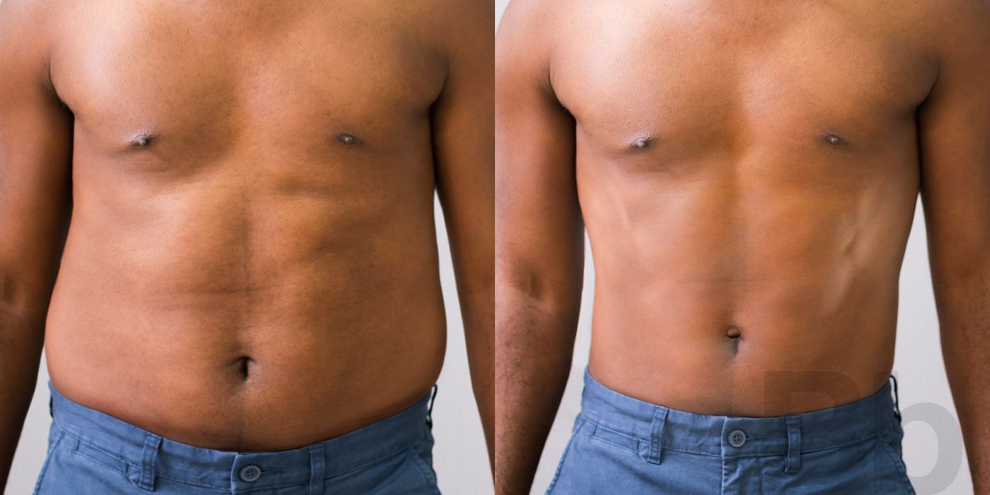 Gynecomastia - Case 68