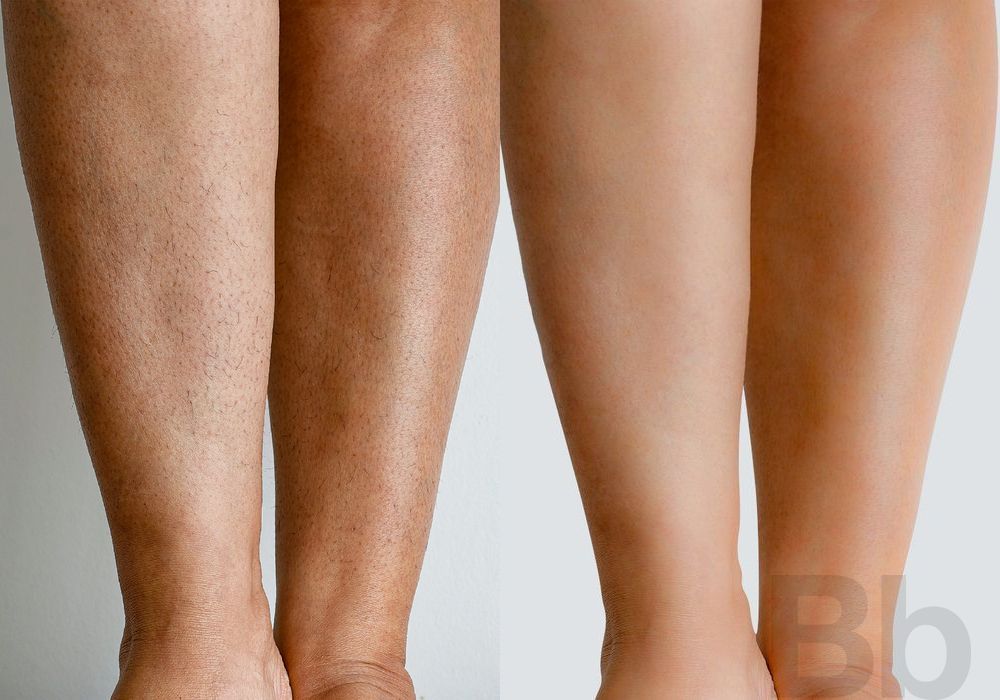 Laser Hair Reduction - Case 124