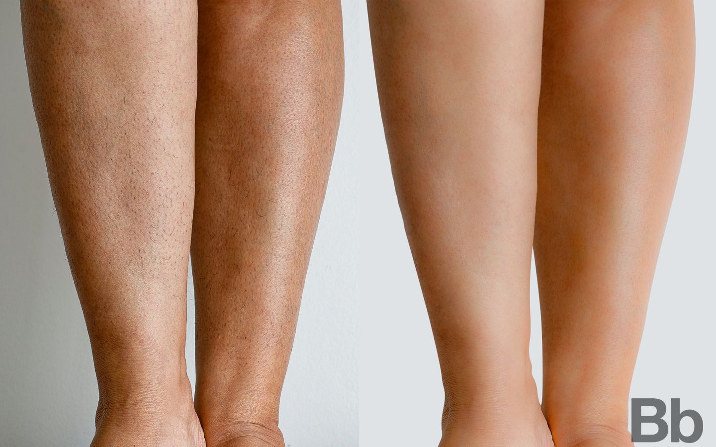 Before and after Laser Hair Reduction case 4756