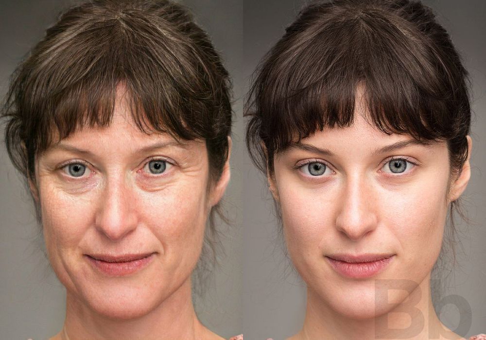 Laser Skin Resurfacing - Case 130