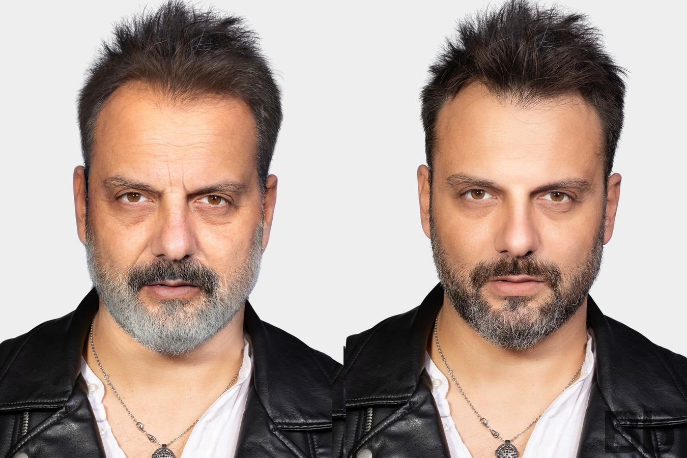 Before and after Laser Skin Resurfacing case 4751