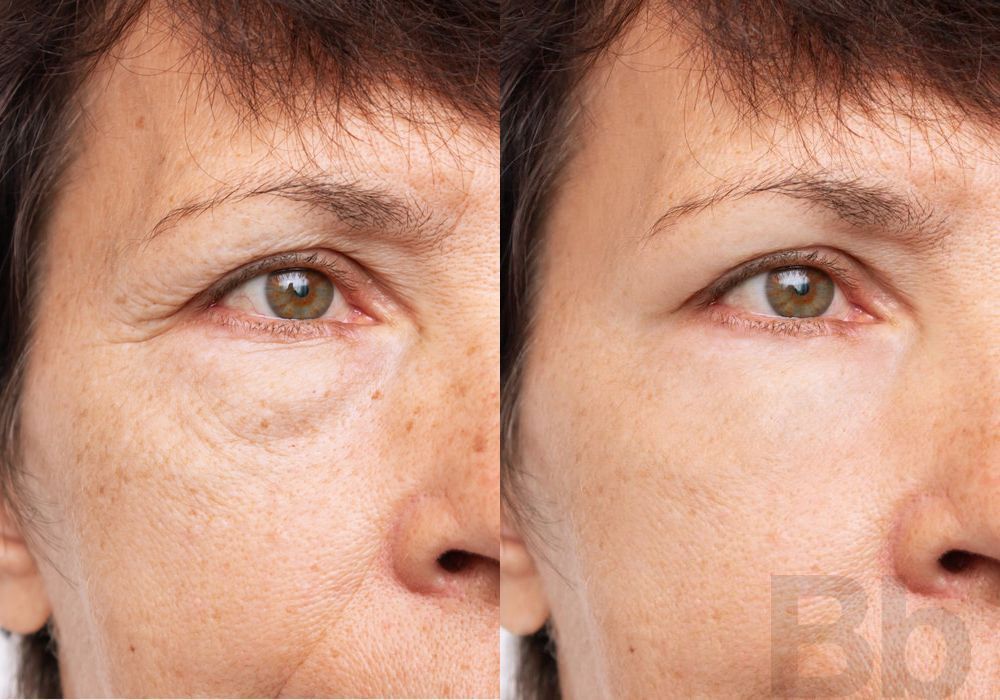 Laser Skin Resurfacing - Case 135