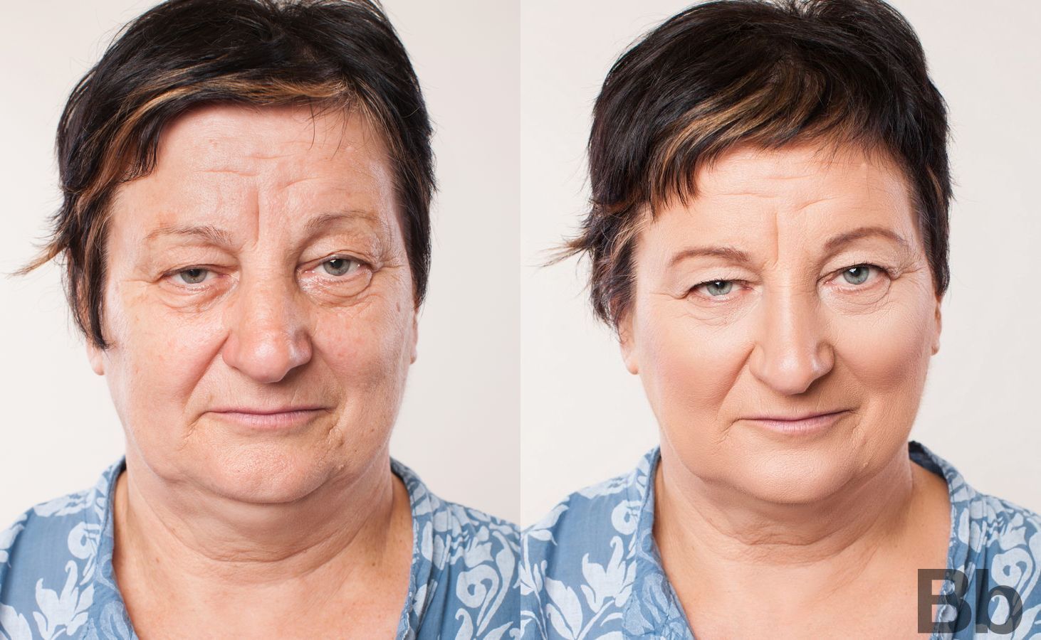 Before and after Laser Skin Resurfacing case 4752