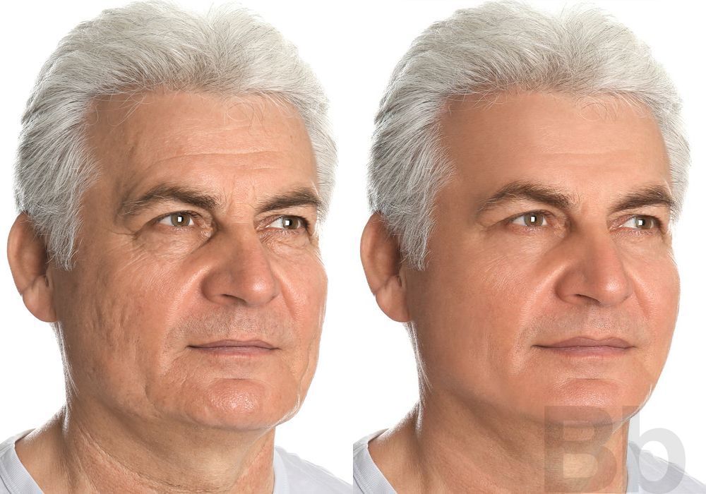 Laser Skin Resurfacing - Thumbnail 2