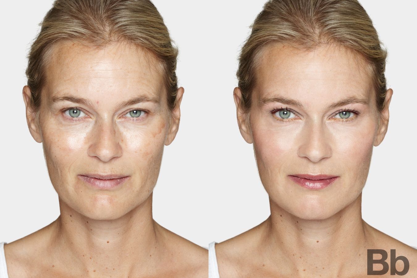 Before and after Laser Skin Resurfacing case 4749