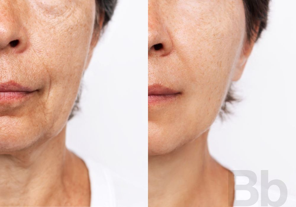 Laser Skin Resurfacing - Case 134