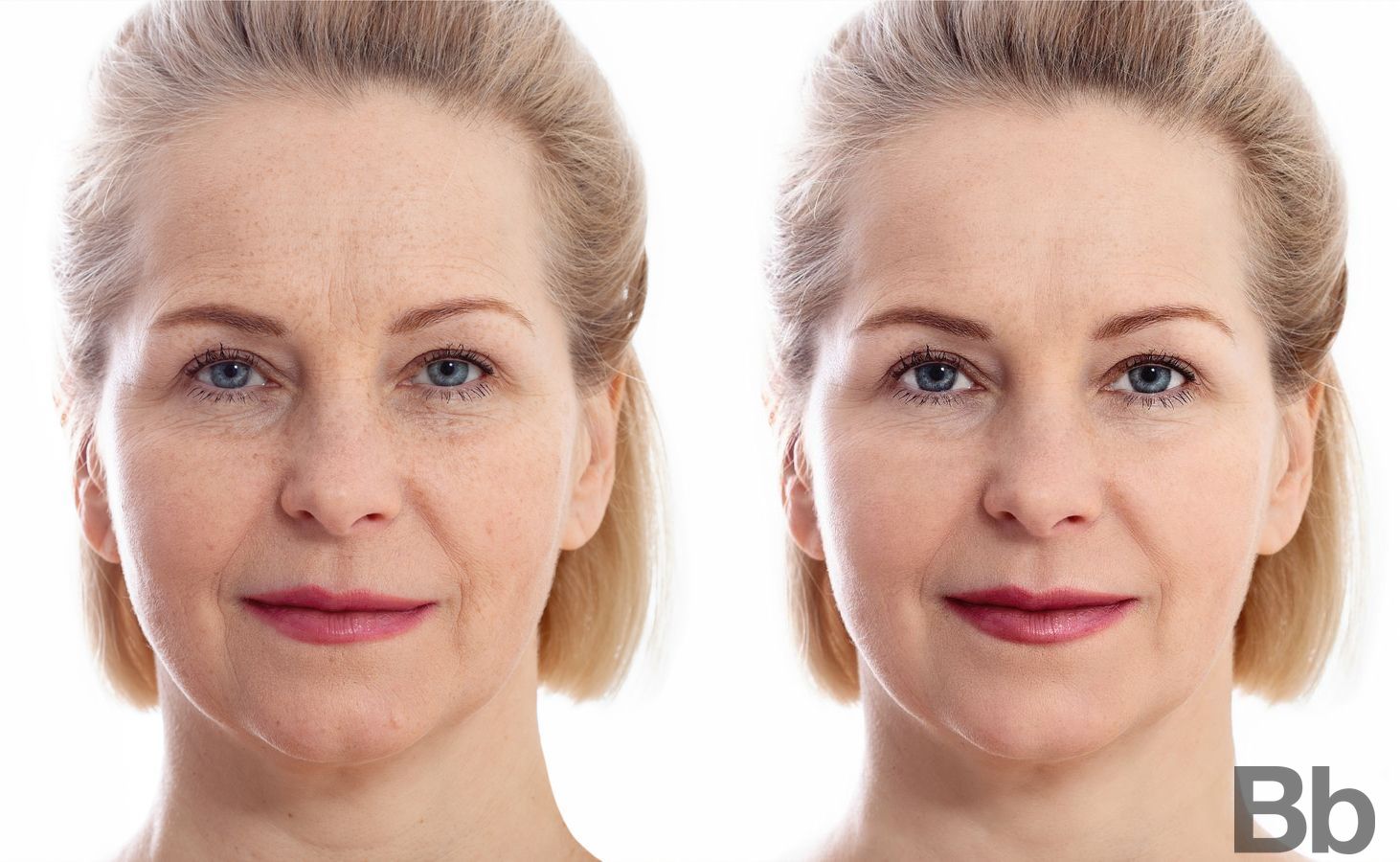Before and after Laser Skin Resurfacing case 4753