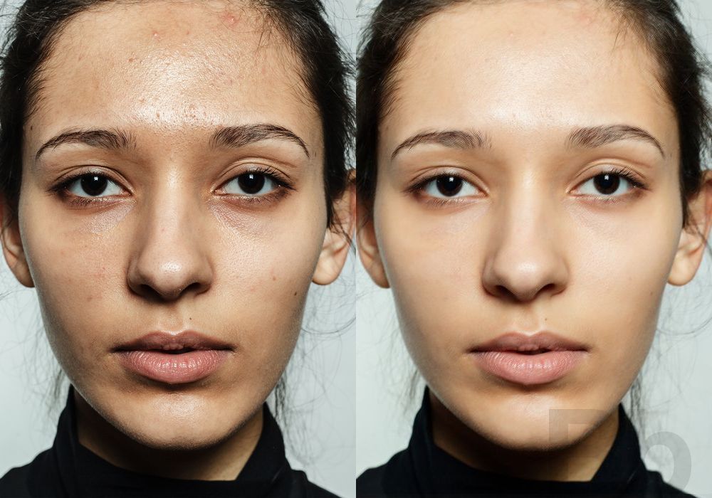 Laser Skin Resurfacing - Case 133