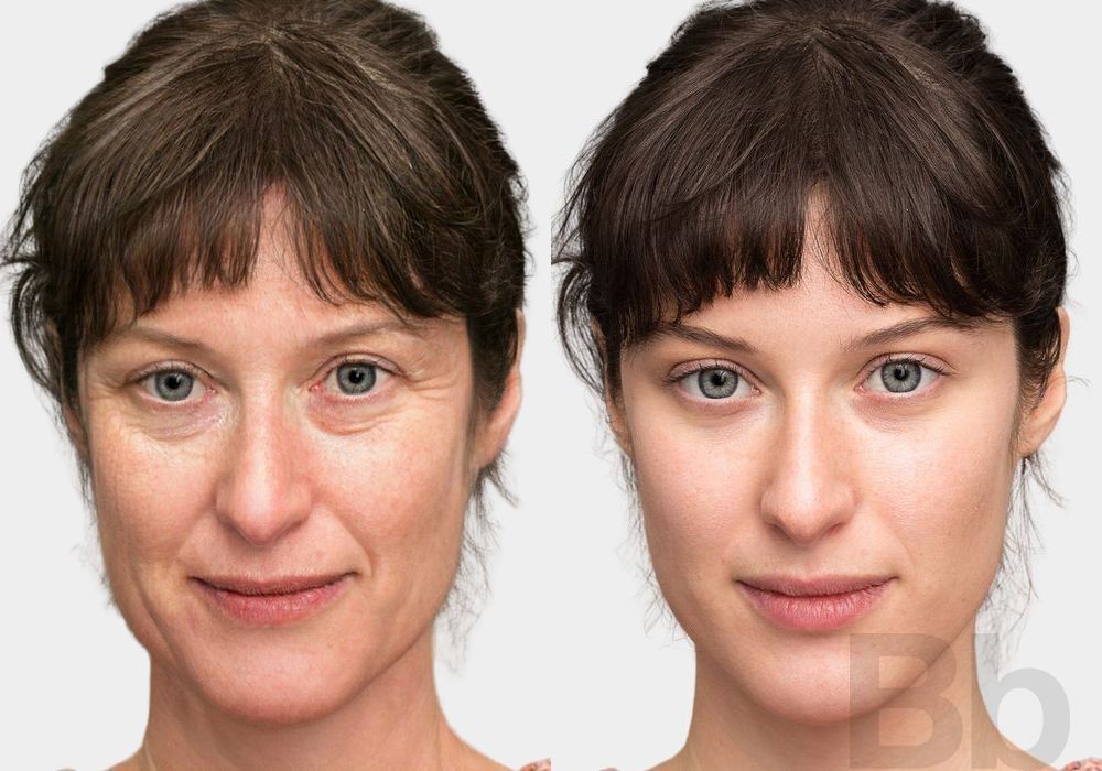 Laser Skin Resurfacing - Case 126