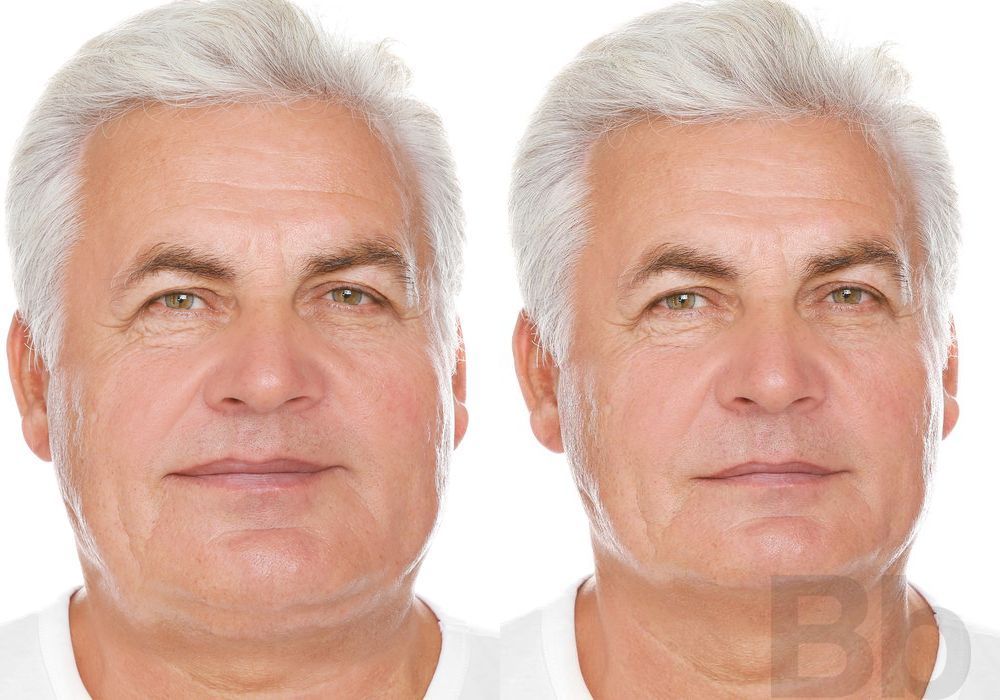 Laser Skin Resurfacing - Case 132