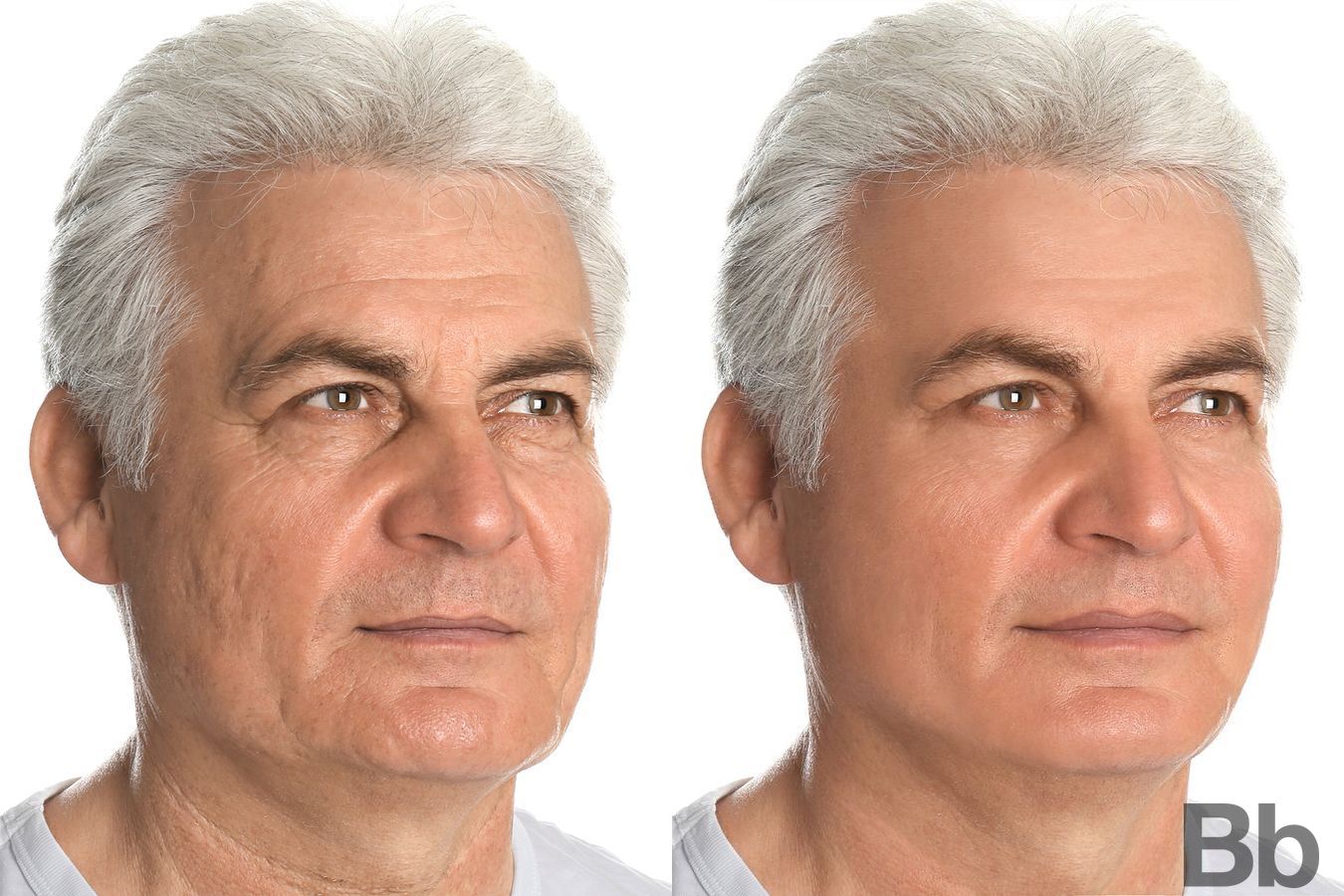 Before and after Laser Skin Resurfacing case 4766 - Angle 2