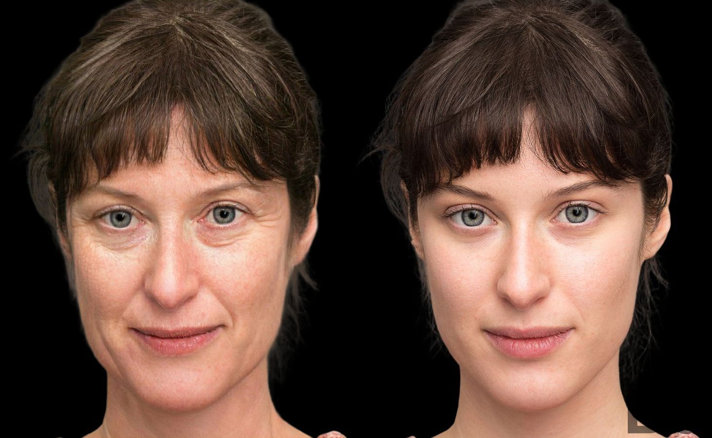 Before and after Laser Skin Resurfacing case 4754