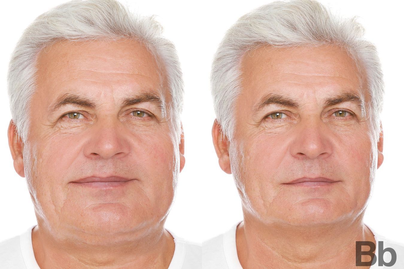 Before and after Laser Skin Resurfacing case 4766