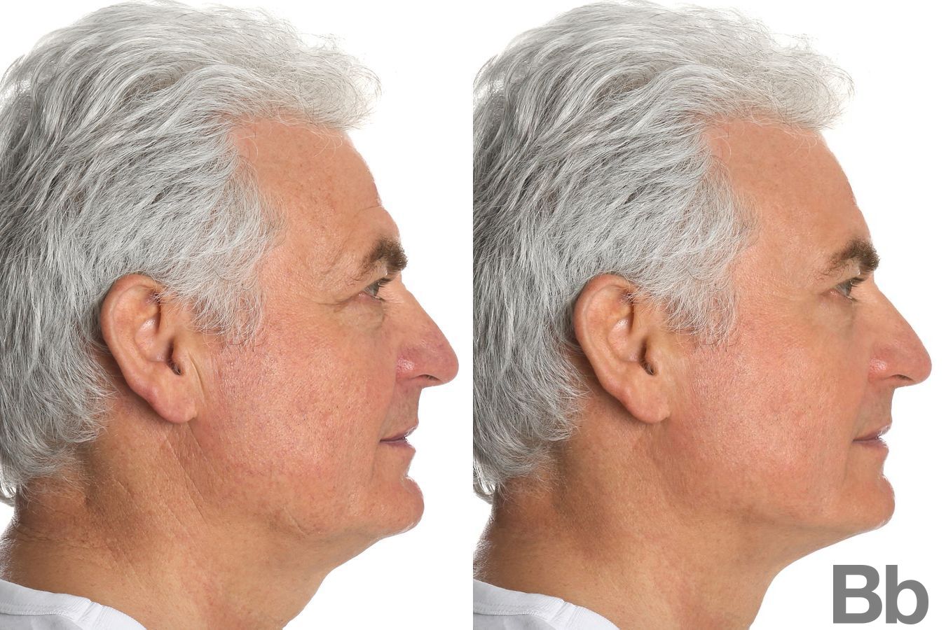 Before and after Laser Skin Resurfacing case 4766 - Angle 3