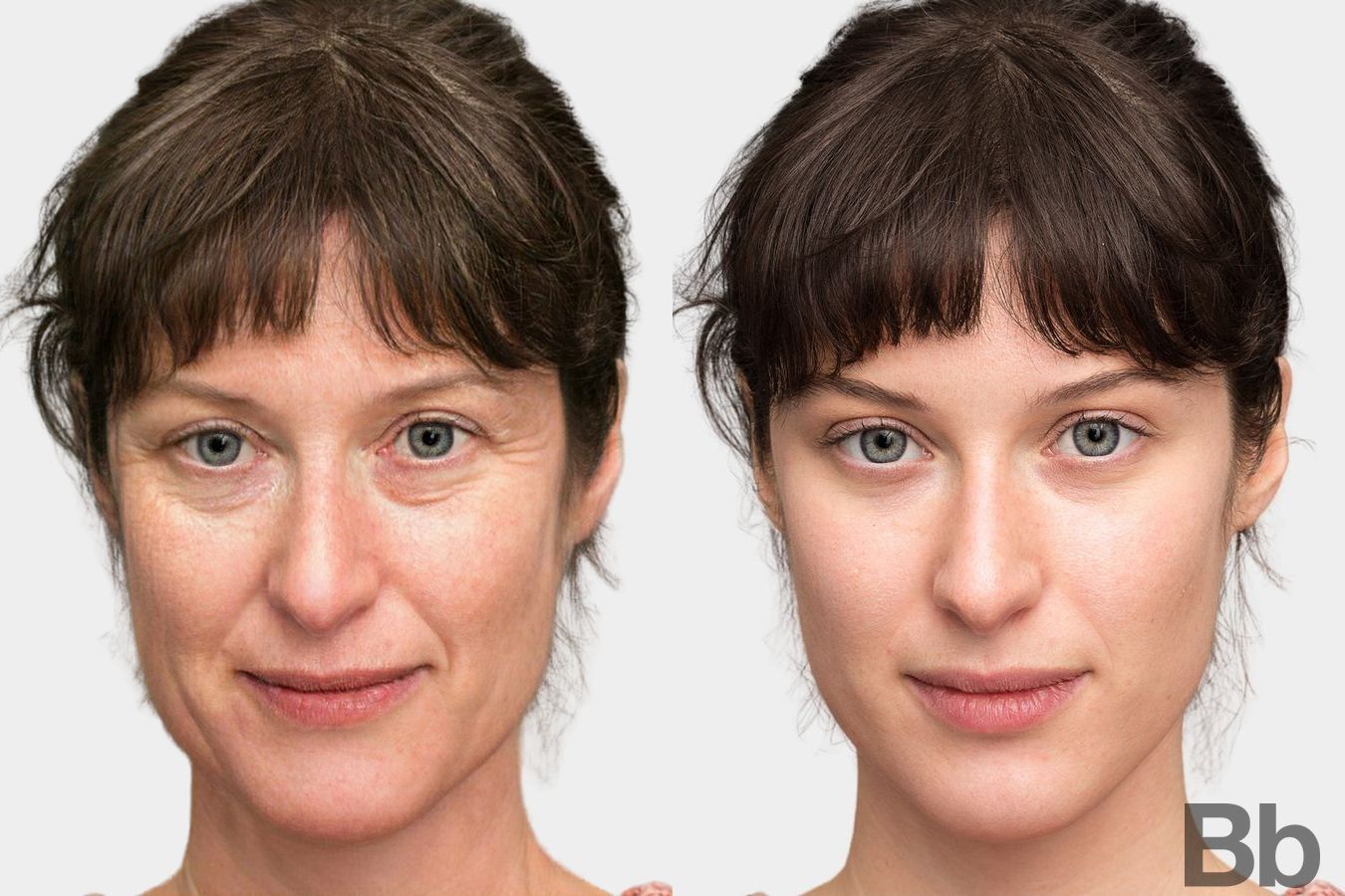 Before and after Laser Skin Resurfacing case 4750