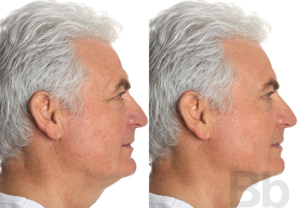 Laser Skin Resurfacing - Thumbnail 3