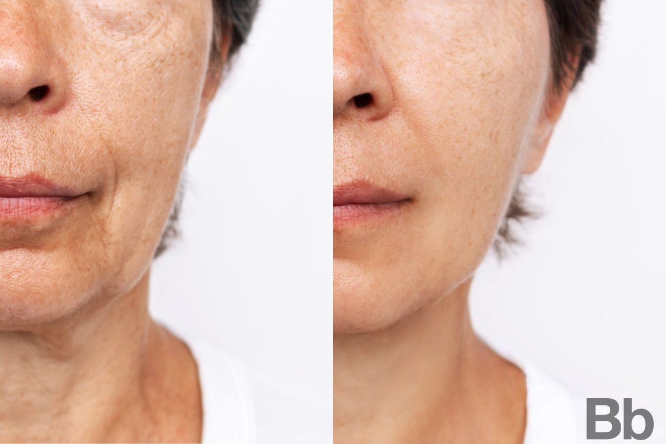 Before and after Laser Skin Resurfacing case 4773