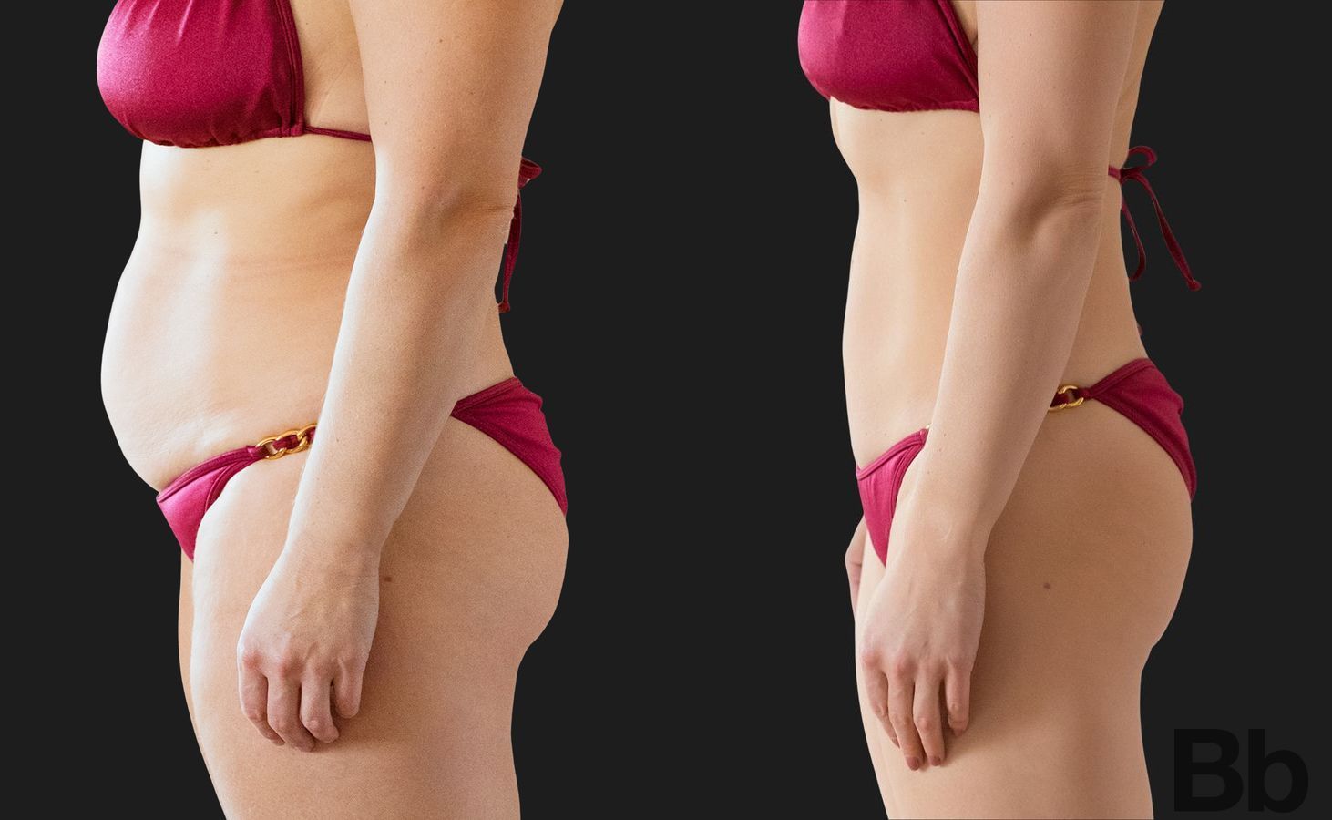 Before and after Liposuction case 23890 - Angle 2