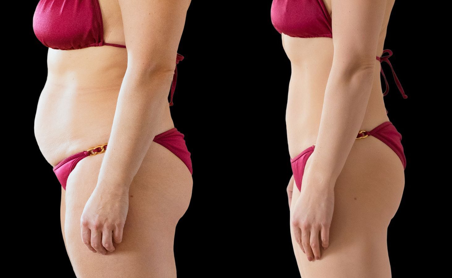 Before and after Liposuction case 4765 - Angle 3