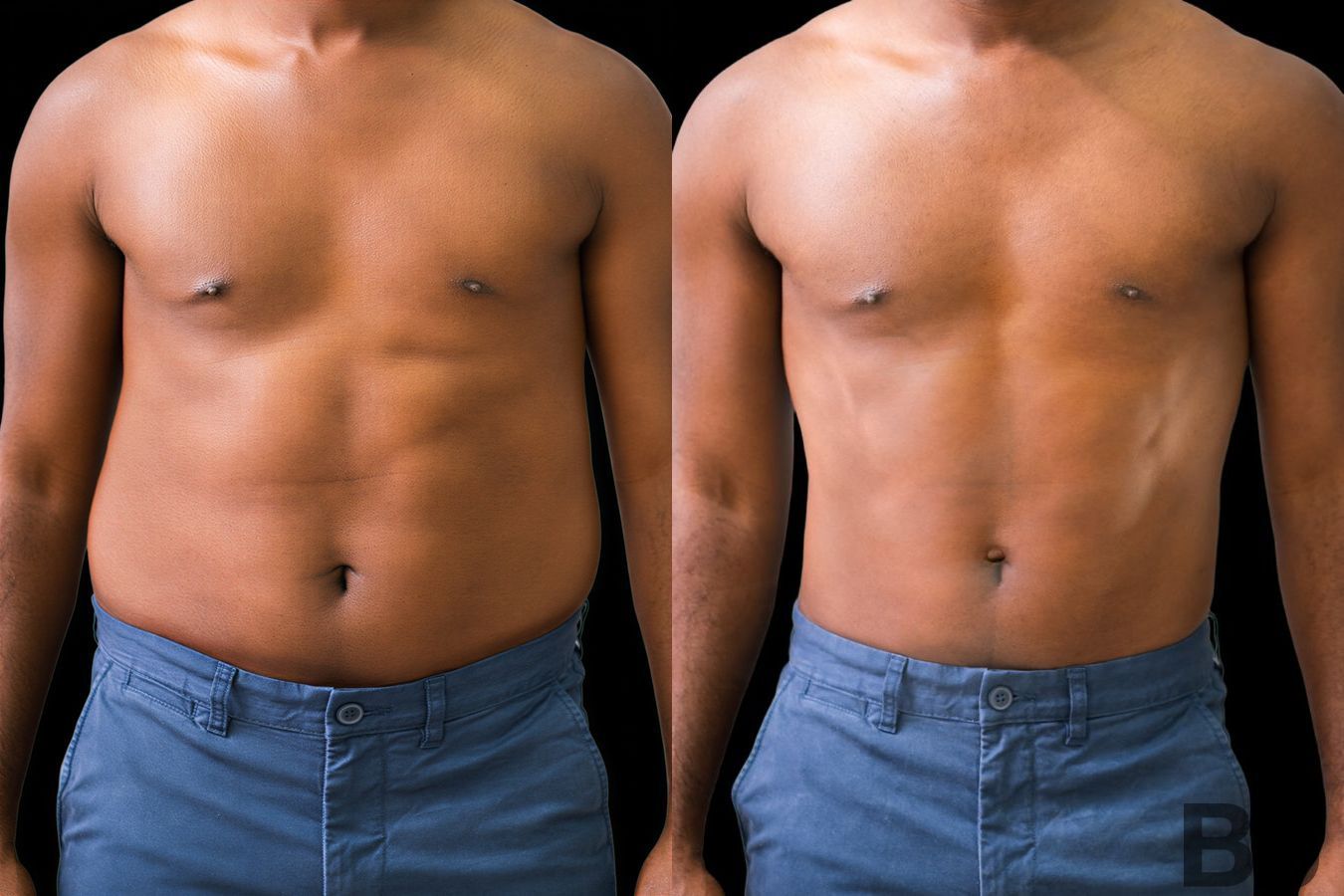 Before and after Liposuction case 23997