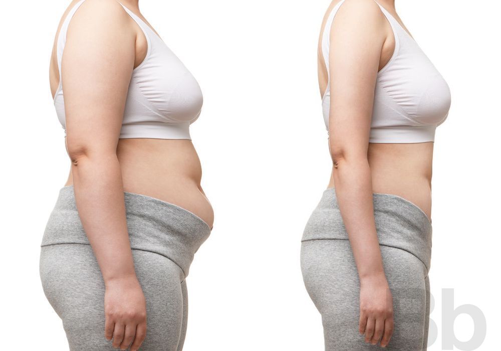 Liposuction - Case 30