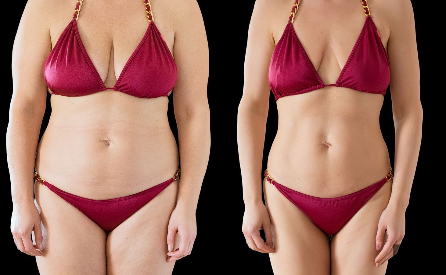 Before and after Liposuction case 4765 - Angle 2