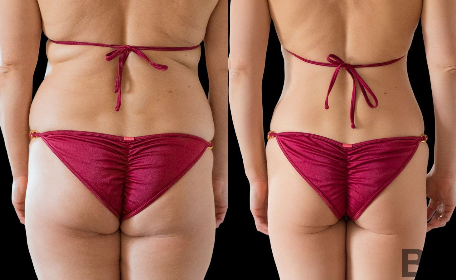 Before and after Liposuction case 4765