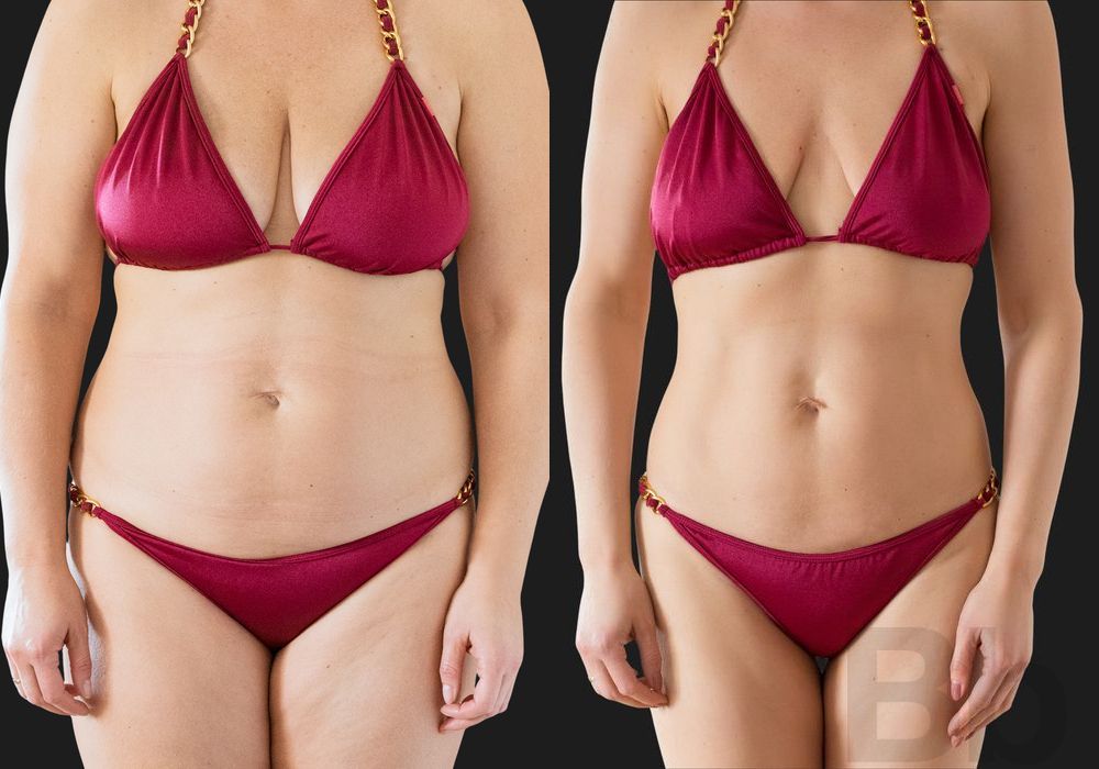 Liposuction - Case 33