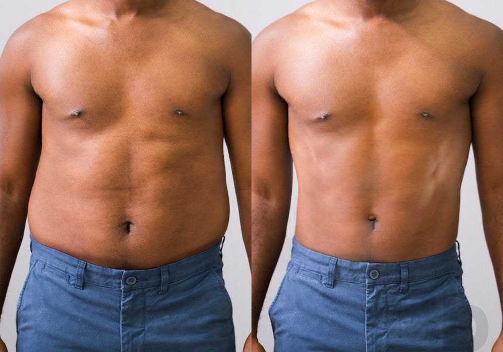Liposuction - Case 25