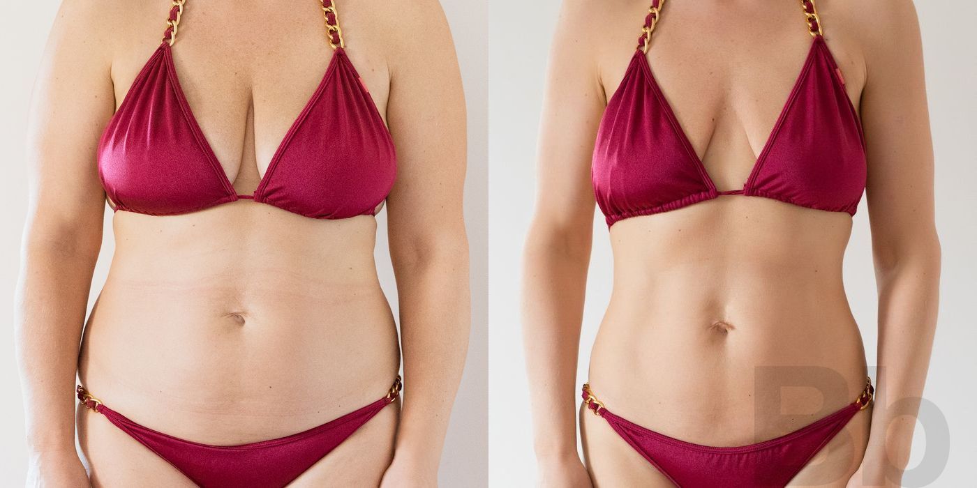 Liposuction - Thumbnail 2