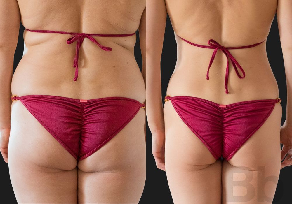 Liposuction - Thumbnail 3