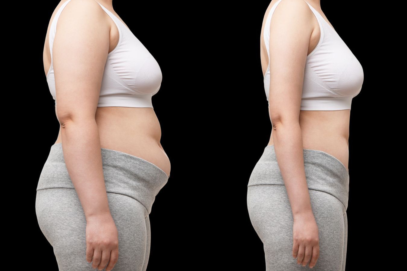 Before and after Liposuction case 12334 - Angle 2